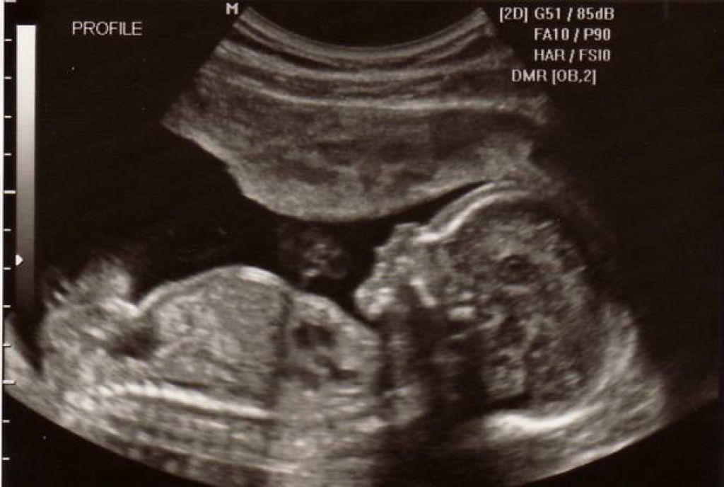 недорогое УЗИ определение пола ребёнка недорогое УЗИ определение пола ребёнка